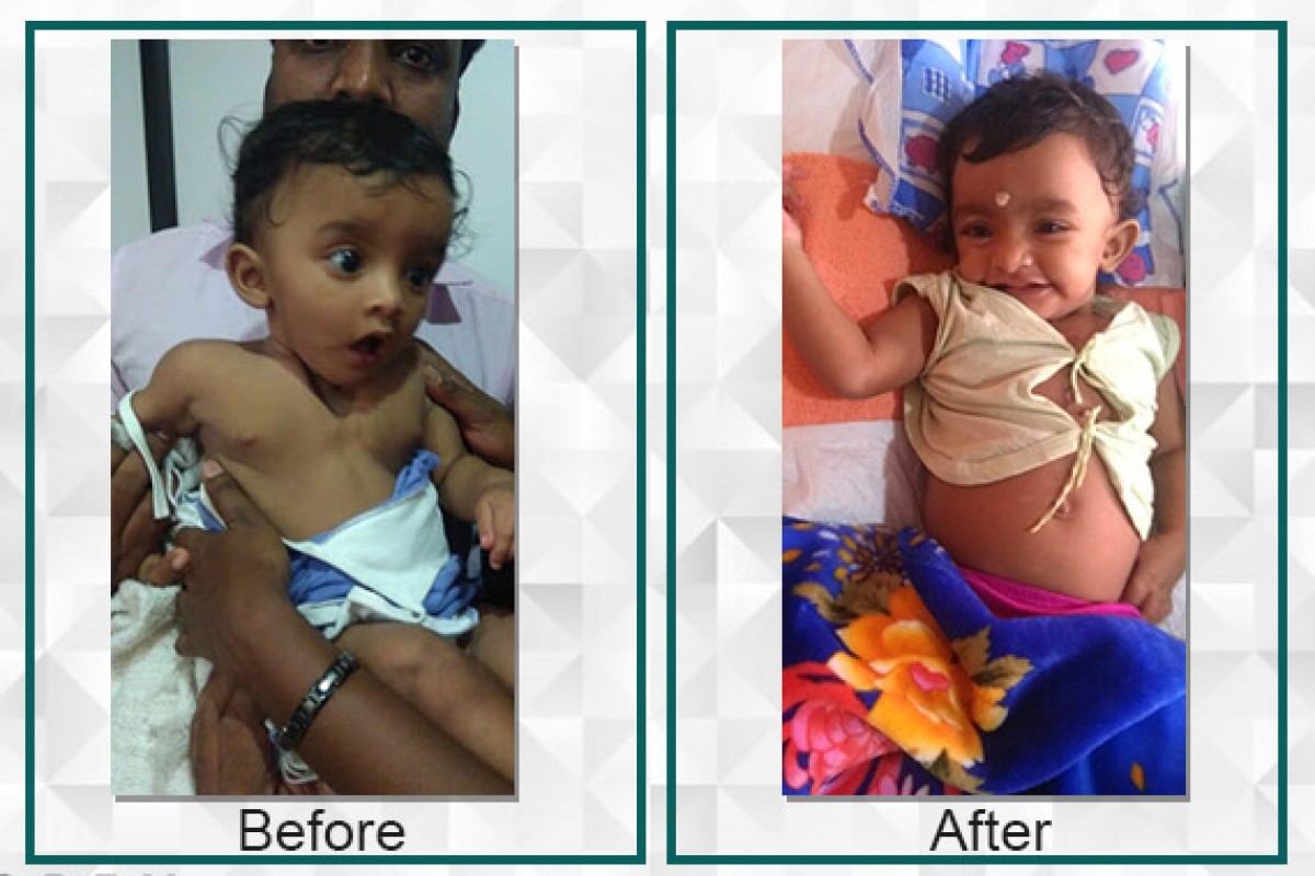 Athmika suffered from Congenital Agenesis but with the help of the raised funds she is now living a normal life