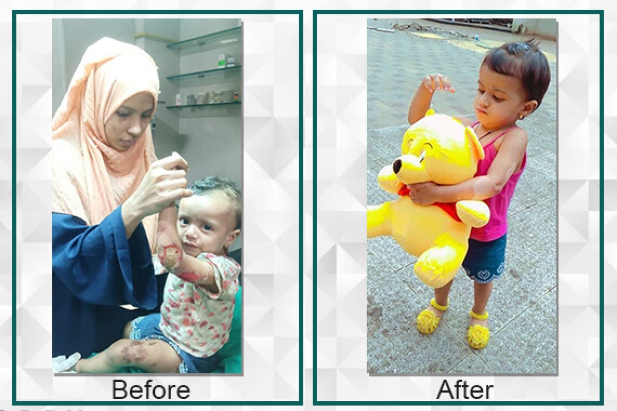 Naba has become the star after surgery and she is a more active child now