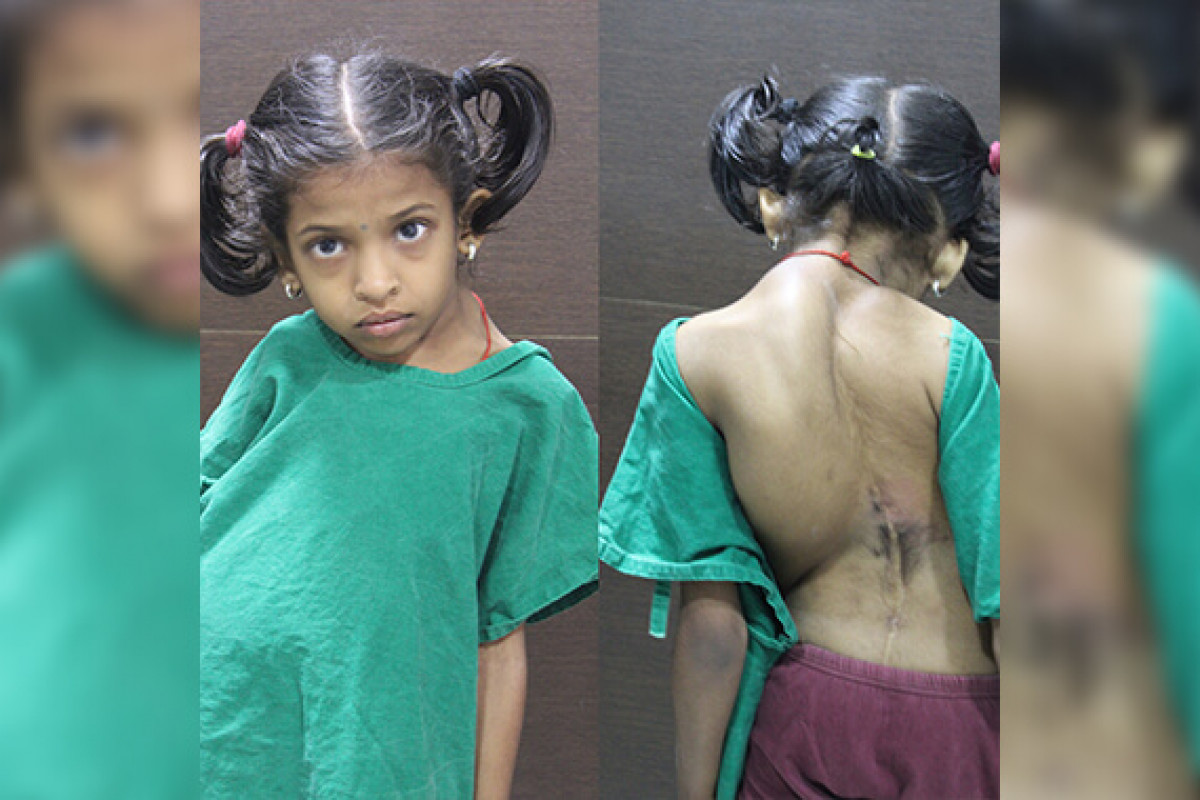 Apoorva Battles Kyphoscoliosis, Help Her Fight the Disease