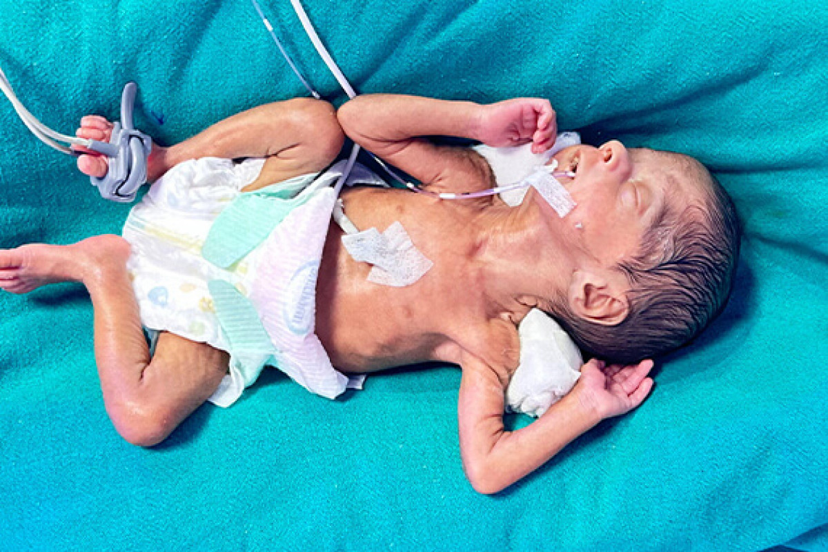 Newborn Baby Soni Azad’s Life in Danger, Please Save Him