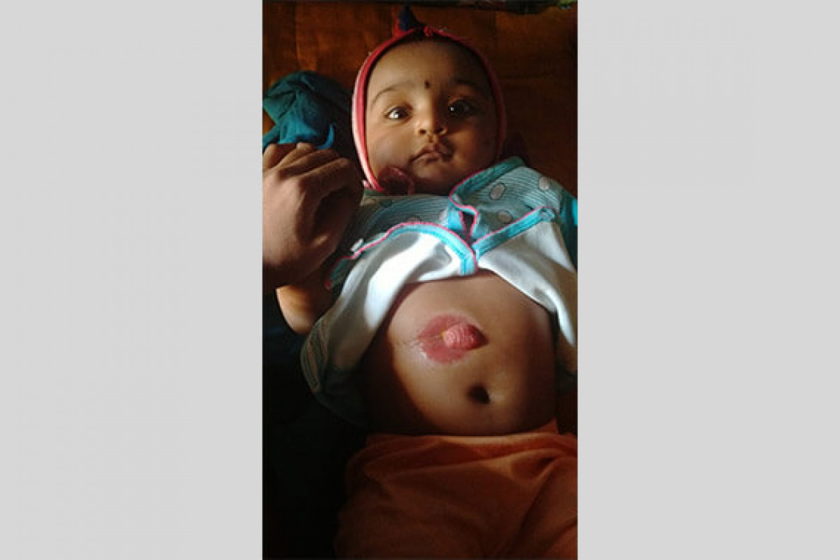 Anvi, 5 months old is born with Hirschsprung’s disease. She needs your help in her treatments
