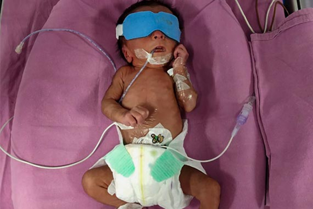 Support Harbai and Ram to save the lives of their Miracle Twins
