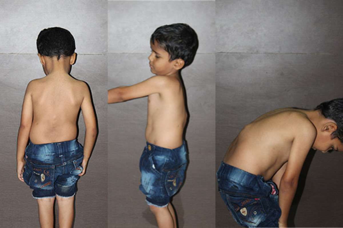 Santosh's spinal deformity is preventing him from living a happy childhood. Help him!