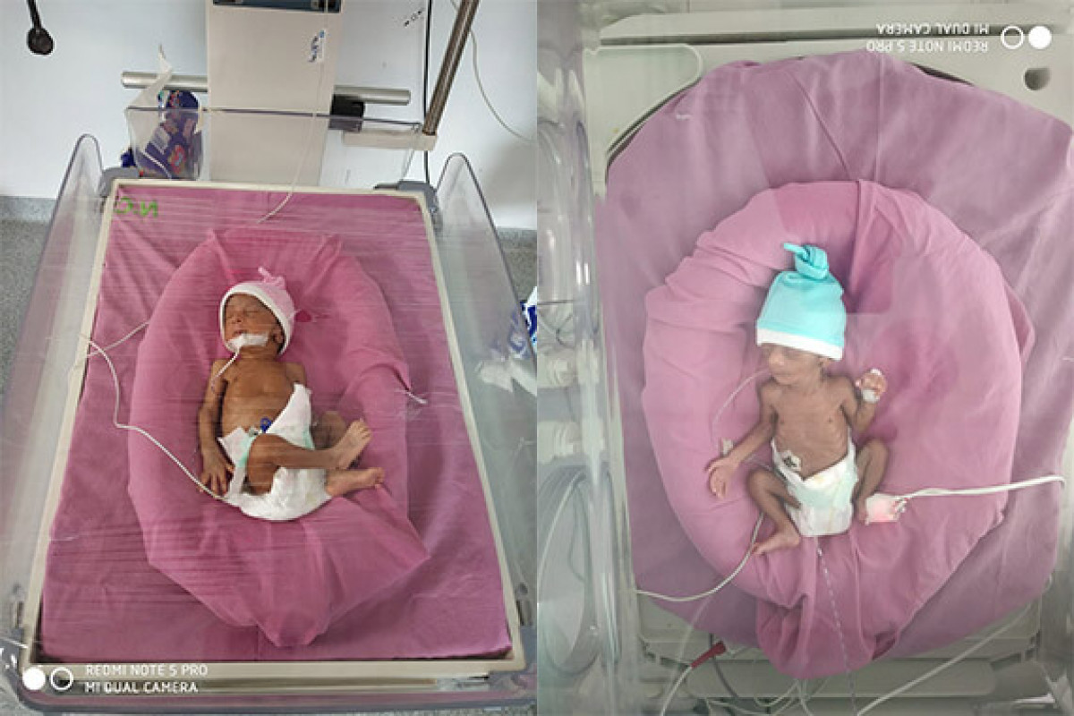 26-day old twins are preterm babies who require your help to stay at NICU to recover faster