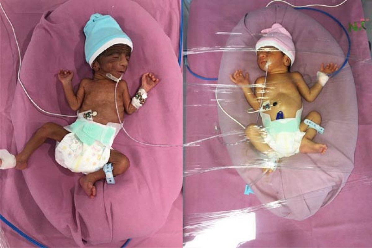 Twins of Lila are struggling for life in the NICU. Please Help!