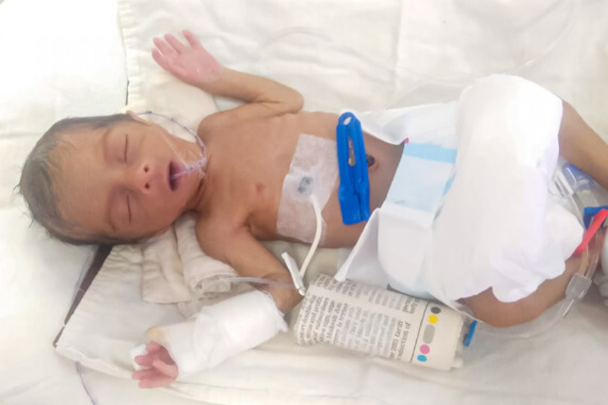 Help a 10-day old baby to survive premature birth complications