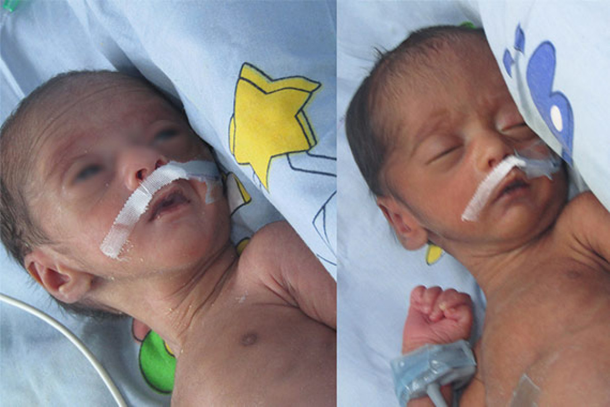 Premature Newborns of Jyothi Are Fighting for Life, Save Them