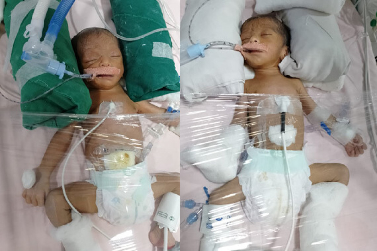 Save 1-day-old twins struggling to breathe in NICU!