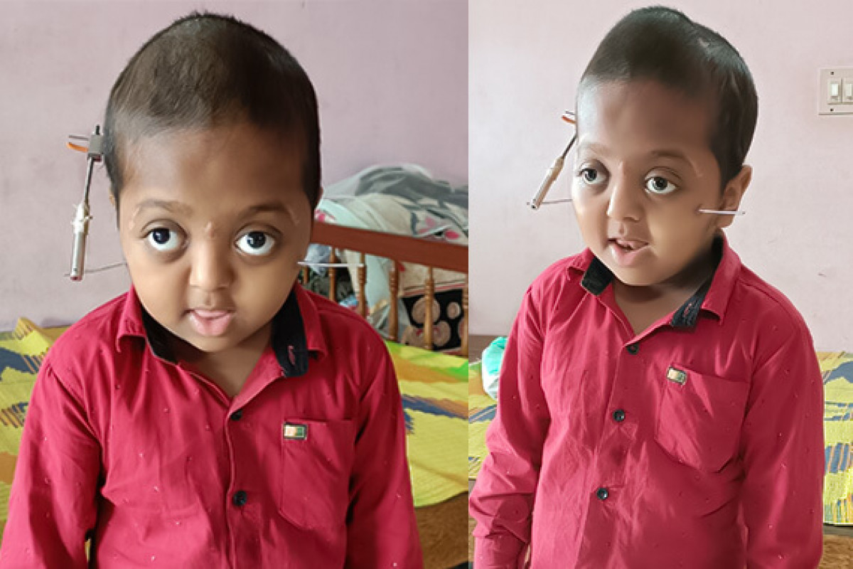 This 4th Surgery Can Save Little Hasnain’s Life. Help Him!