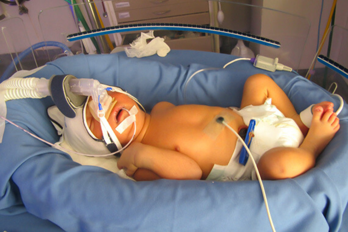 Premature Baby of Uma is suffering from Respiratory Distress. Help him
