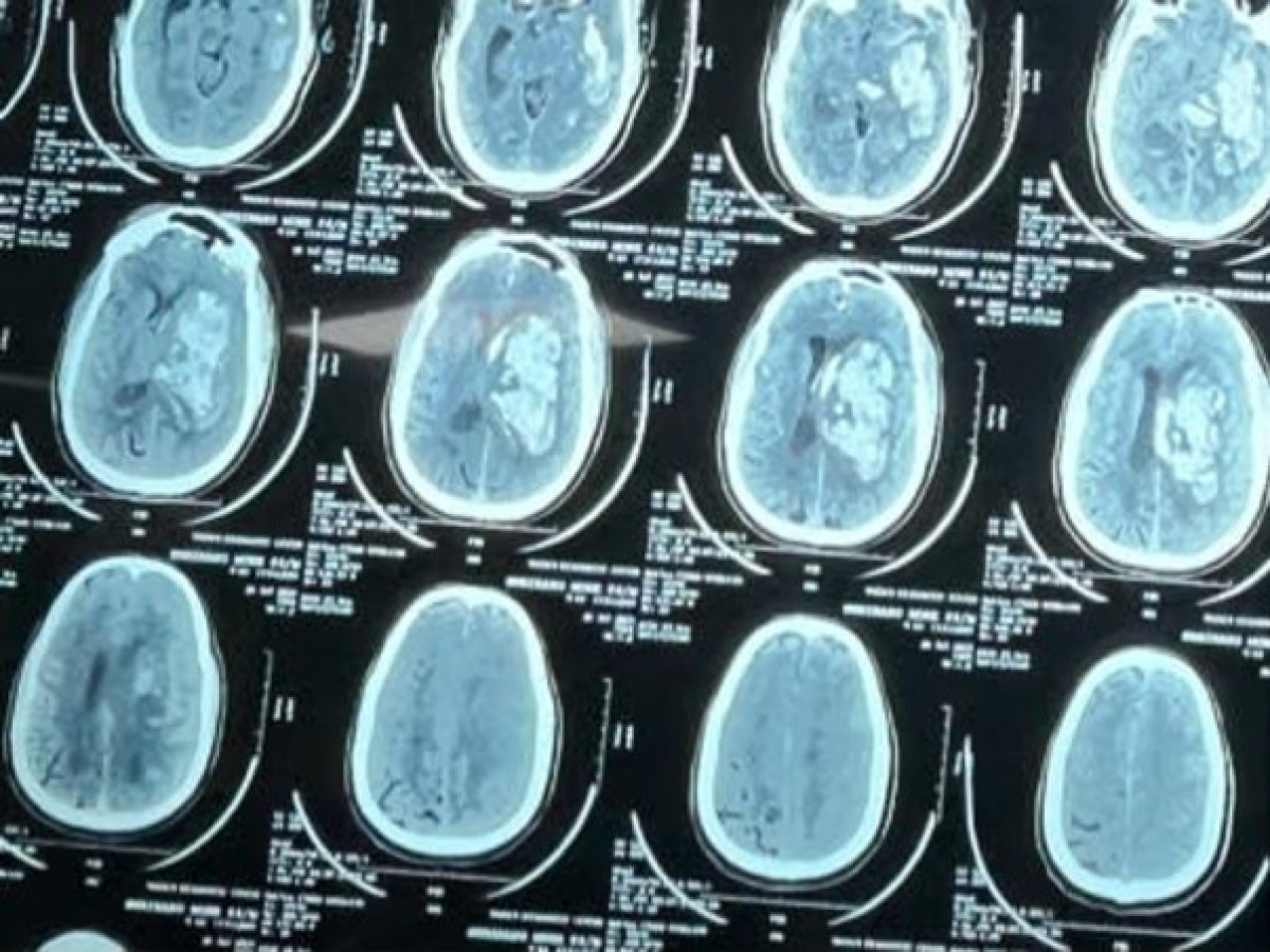 I’m struggling with Brain Stroke, help me 