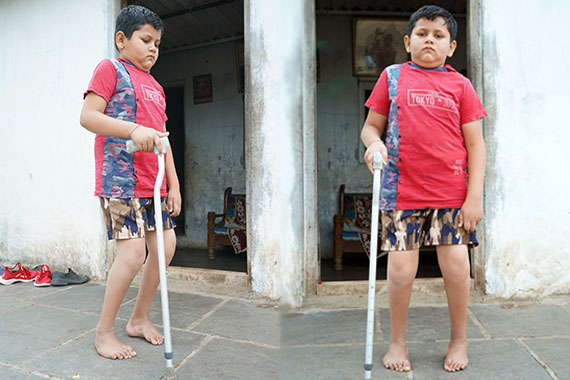Help Kunal's Bilateral Feet Correction so that he can run towards his dreams
