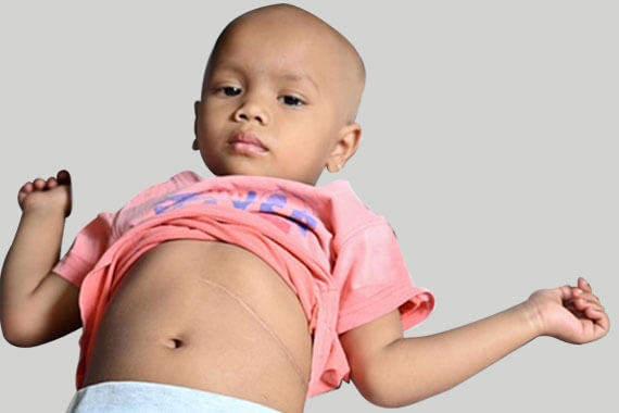 Please support Shravani, a 3-year-old girl who is suffering from Wilms tumour. She needs to undergo chemotherapy immediately
