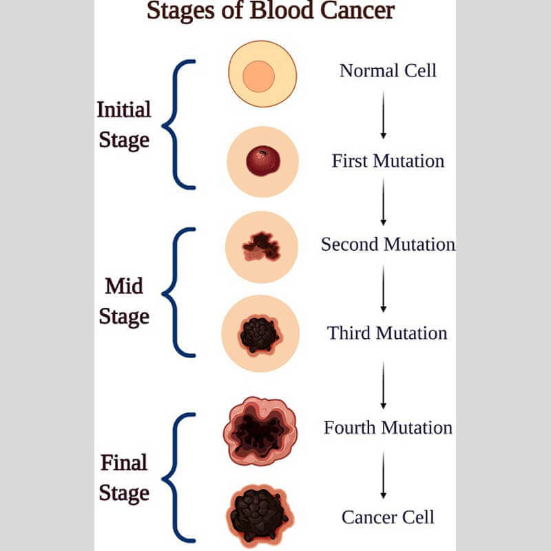 stages of blood cancer