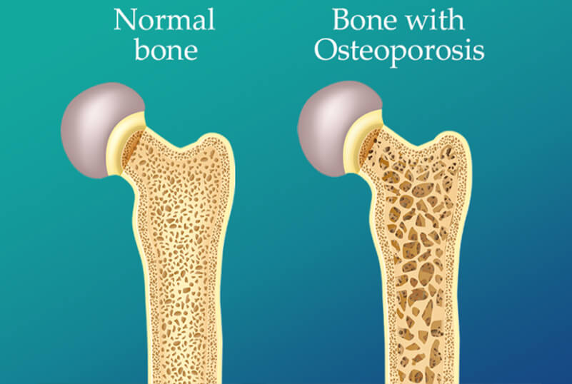 Difference between normal and osteoporosis bone