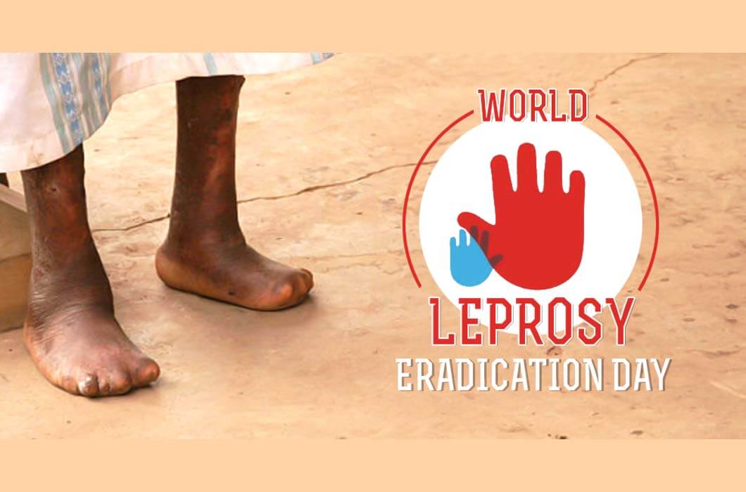 REDUCE STIGMA AGAINST LEPROSY ON WORLD LEPROSY DAY